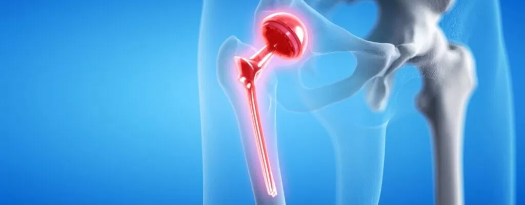 Hip Replacement Rehab Tips